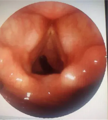 （蚂蝗附在声门处）