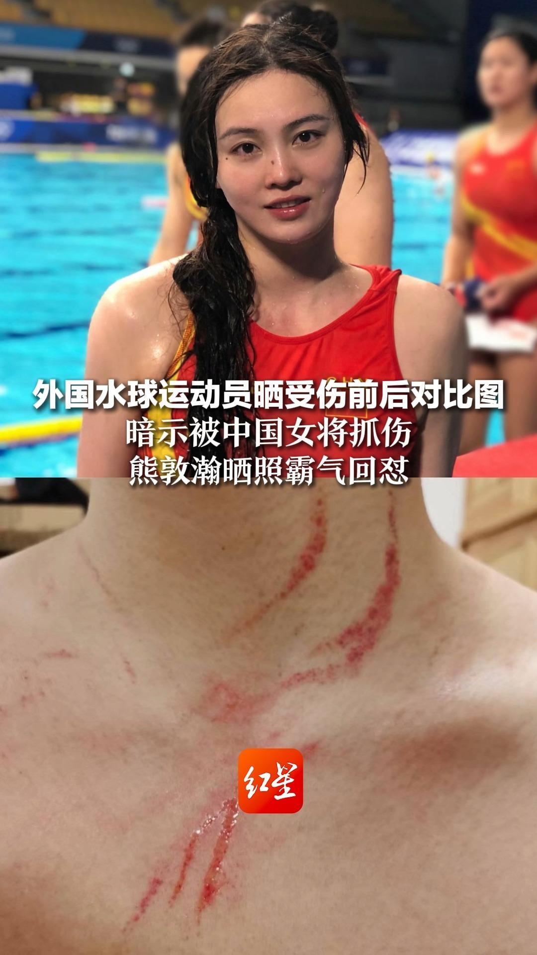外国水球运动员晒受伤前后对比图，暗示被中国女将抓伤，熊敦瀚晒照霸气回怼