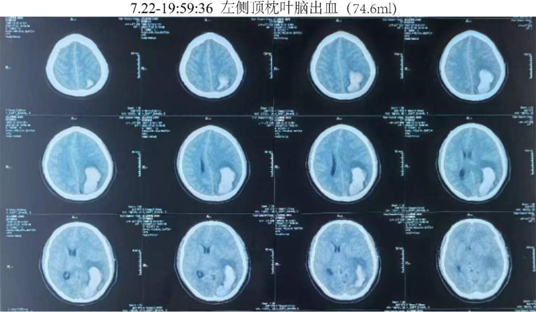 脑出血检查报告图片图片