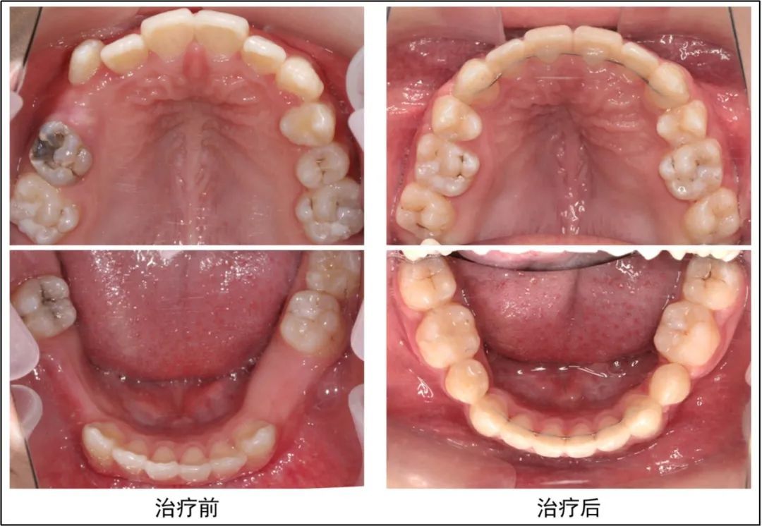患者治疗前后口内照对比