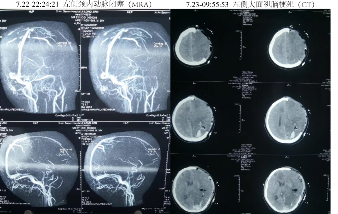 6ml重症脑出血伴大面积脑梗死患者