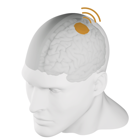 埃隆·马斯克Neuralink试验的第二位患者使用设计软件和视频游戏