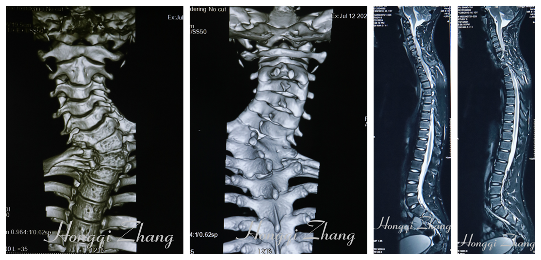 术前CT三维重建及MRI