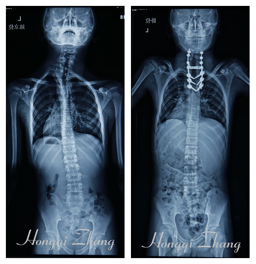 术前（左）、术后（右）X片对比
