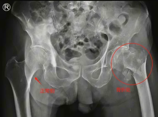 ▲术前双髋关节X片