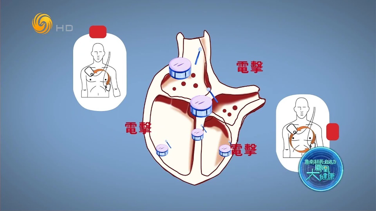 AED为什么能救命？先来看看心脏在骤停之前，到底经历了什么