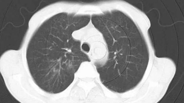 咳嗽治療好轉，剛準備出院，一查 CT 爆炸瞭