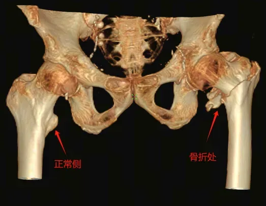 ▲术前CT三维重建