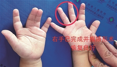 此前男童已接受右手并指矫形术