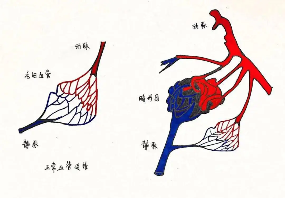 动静脉瘘示意图