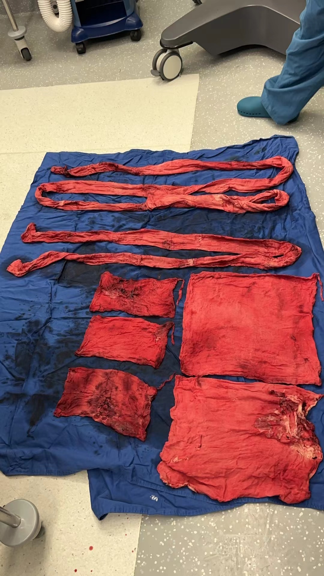 10月14日中大医院多学科联合手术 上图为术中取出的七块压迫纱条及纱垫