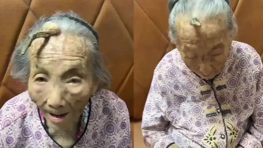 107歲老人額頭長角被稱“長壽角”，醫生：是疾病表現，與年齡、日曬有關