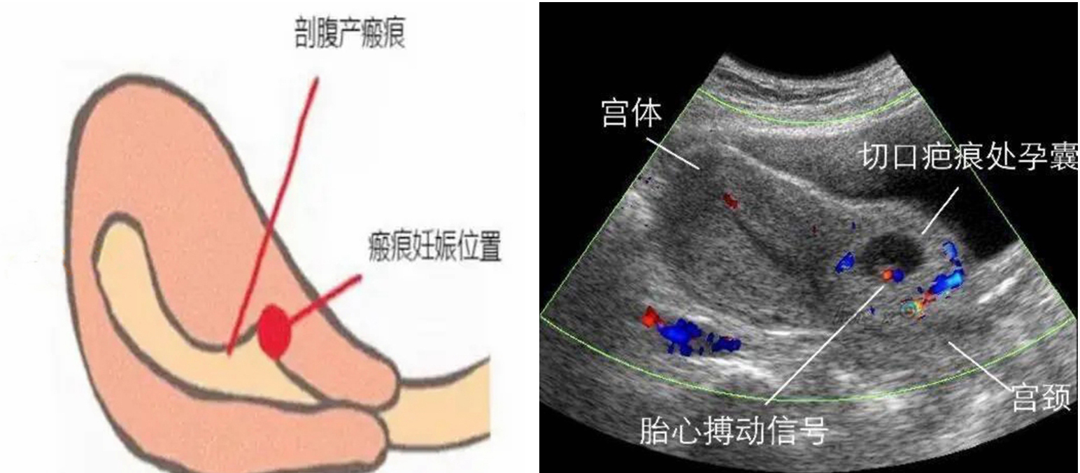 子宫瘢痕妊娠示意图及超声造影显像
