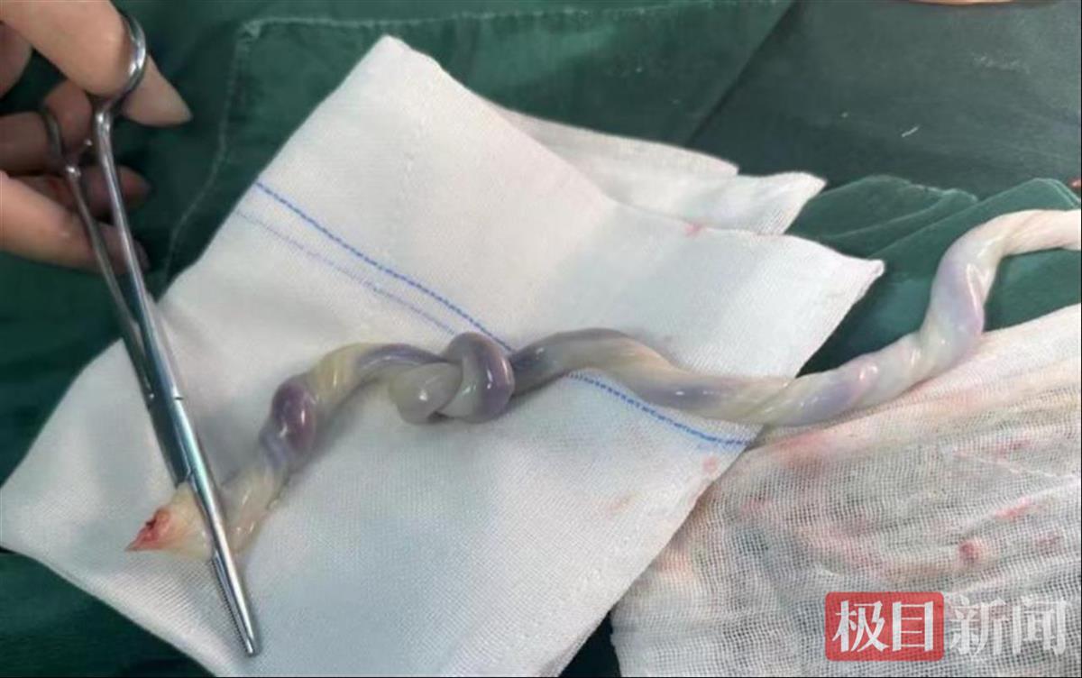 打结的脐带