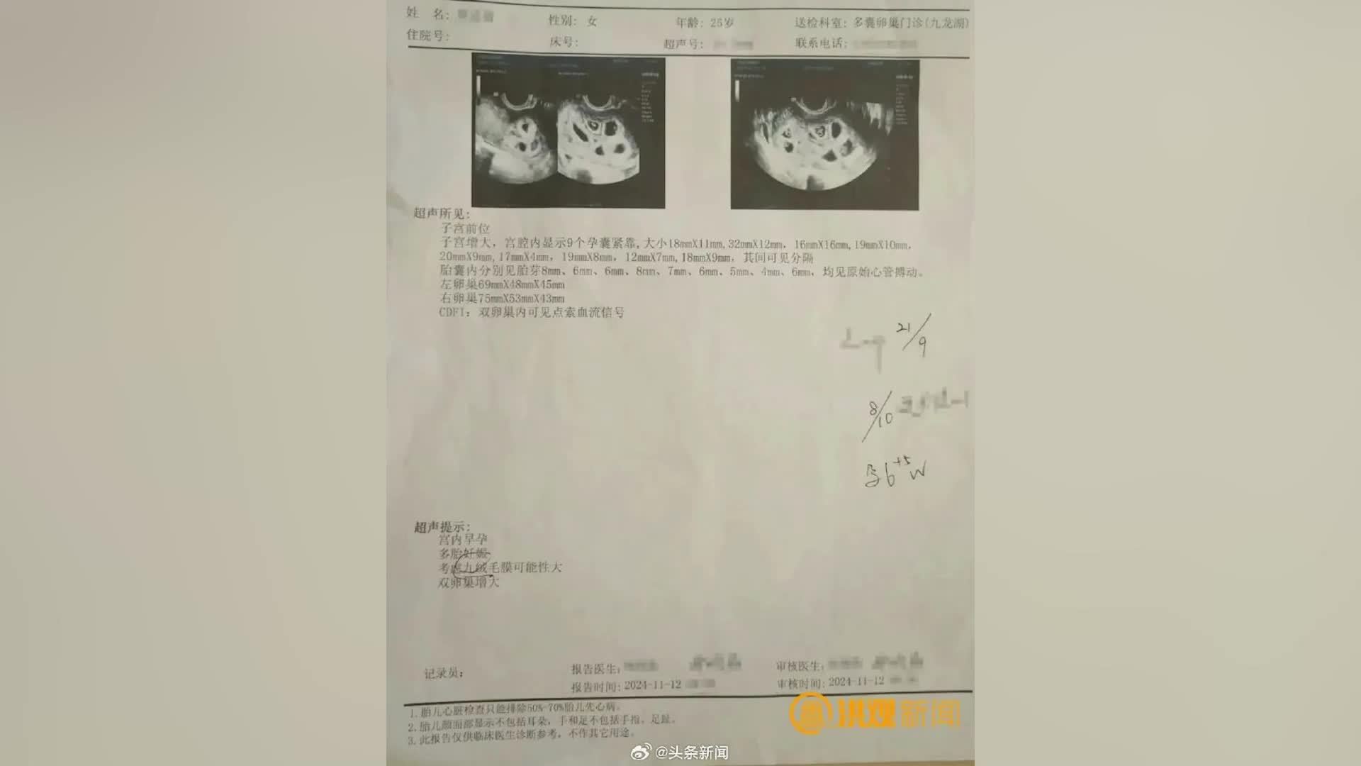 怀9胞胎女子丈夫发声：决定减胎，可能会多次手术