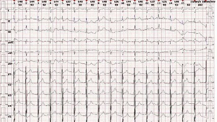 跑步 8 公裡後頭暈入院，當日死亡！看到 CT 恍然大悟：竟是這個原因