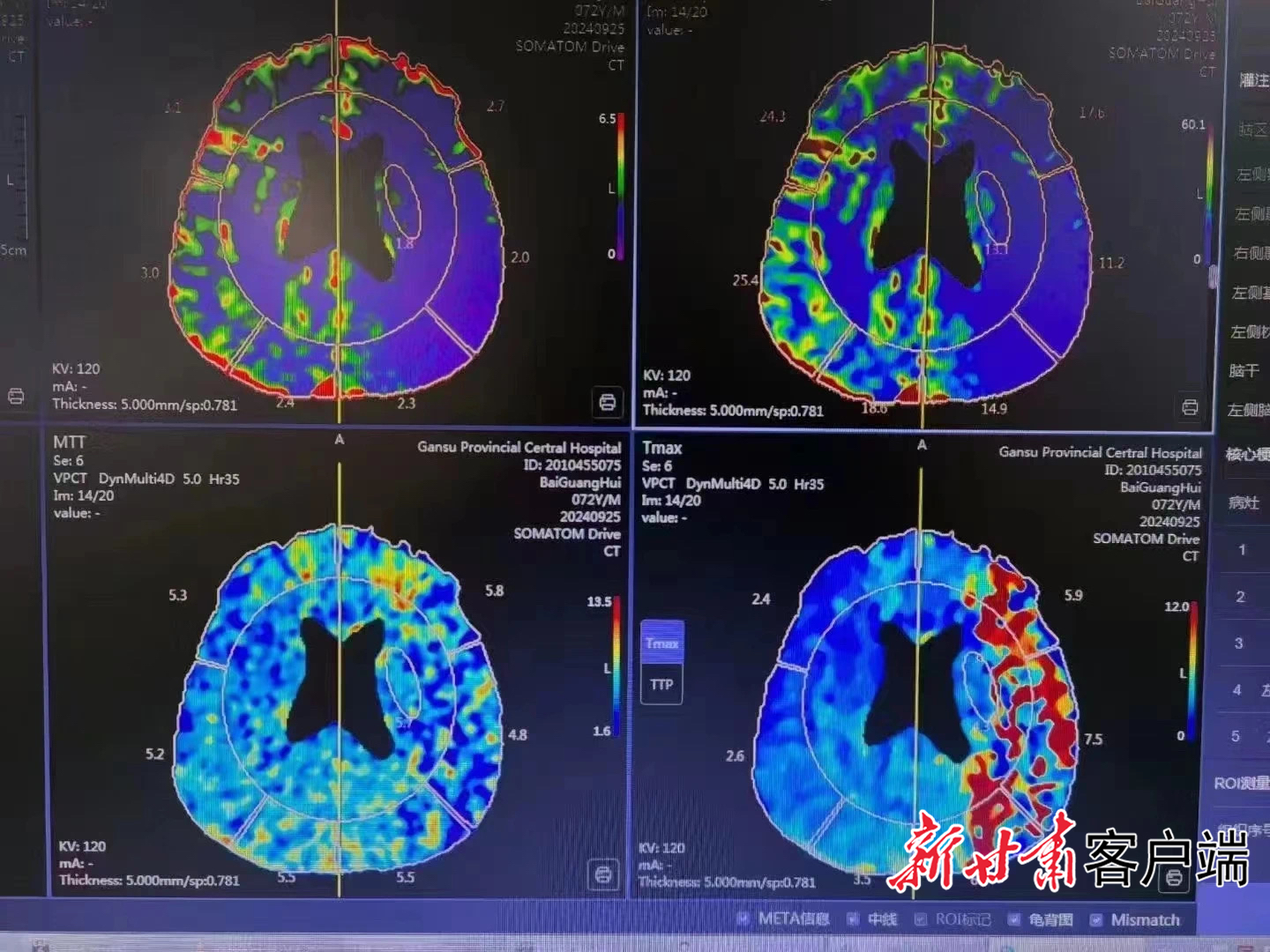 7旬老人突发脑梗　40分钟脱险咋做到的