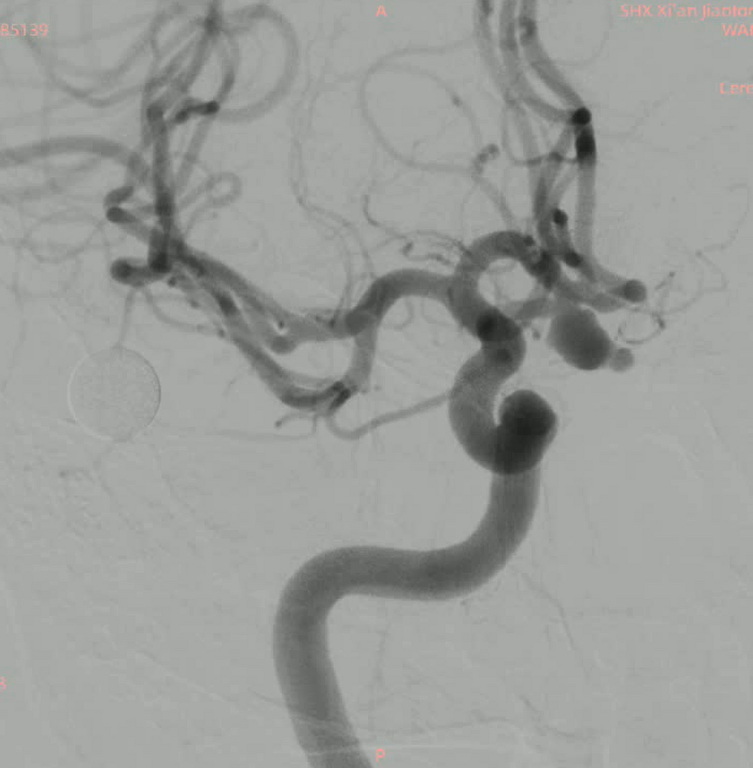 图1 术前前交通动脉瘤显示瘤体远端有子囊