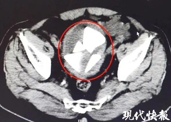 CT显示多个较大的三角形状的结石