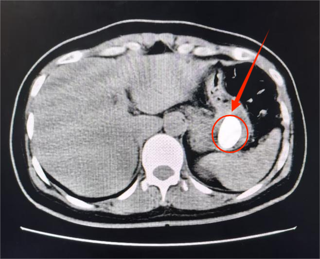 （CT检查：异物为图中圈出位置所示）