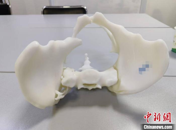 医生利用3D打印技术精确模拟雯雯的骨盆结构,设计复位方案。(武汉大学中南医院供图)