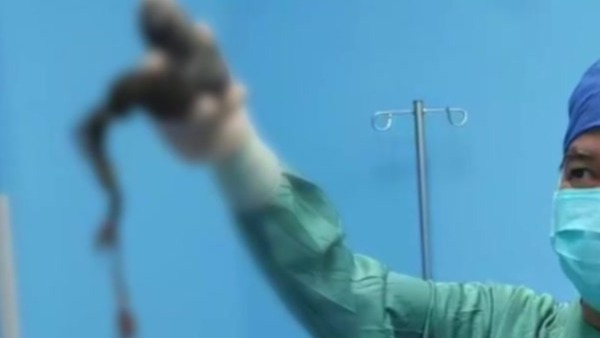 女孩患病，胃里取出直径约4厘米头发团，小肠内索状“头发绳”约30厘米长