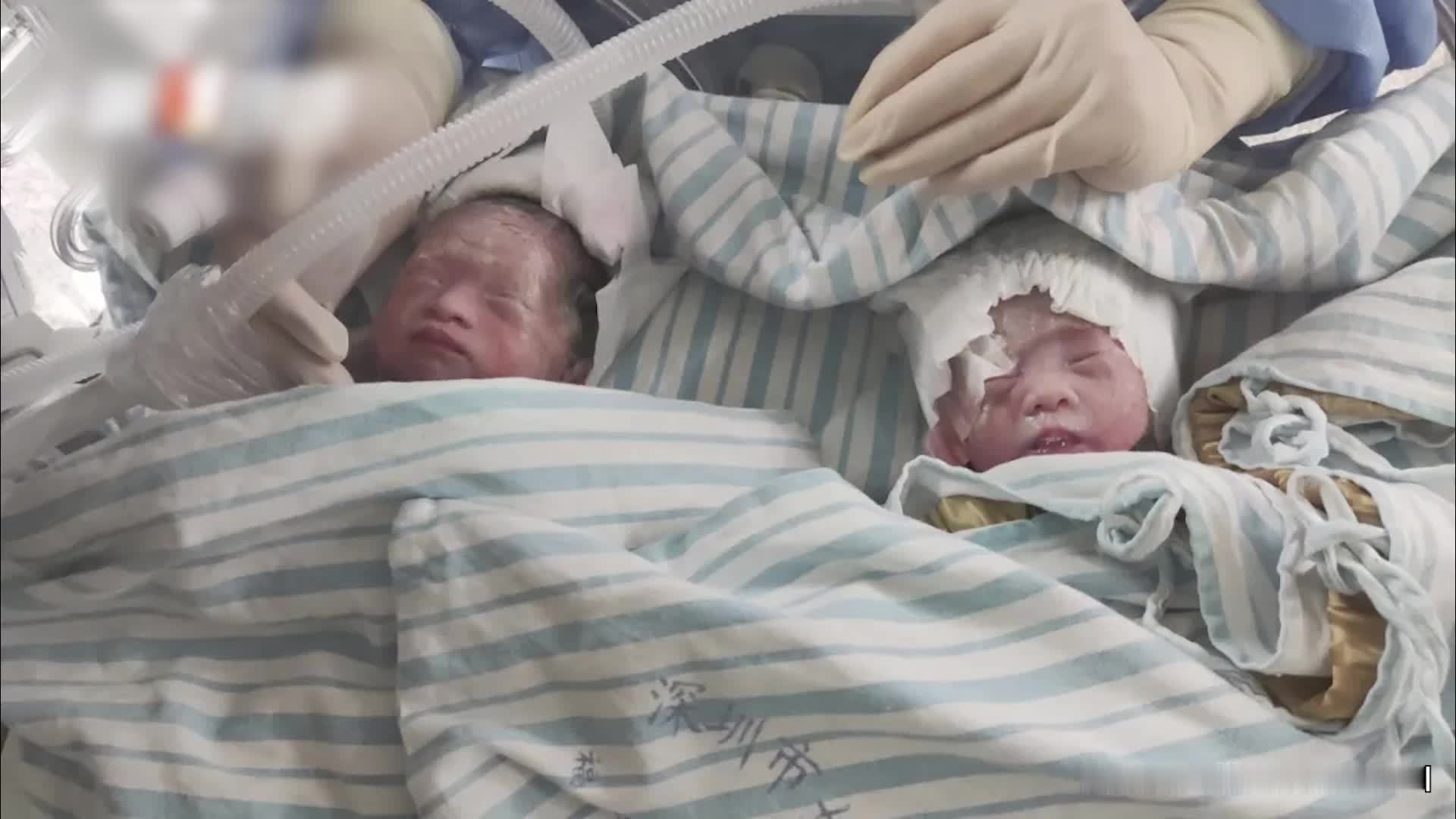 回访深圳宝妈三胎生下四胞胎：孩子已有10斤重，除了妈妈没人能分清