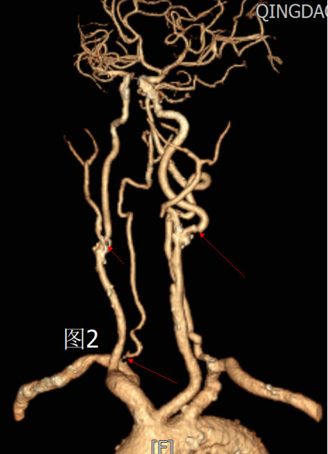 颅脑强化CT显示颈动脉重度狭窄
