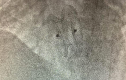 成功封堵大房间隔缺损的X线影像