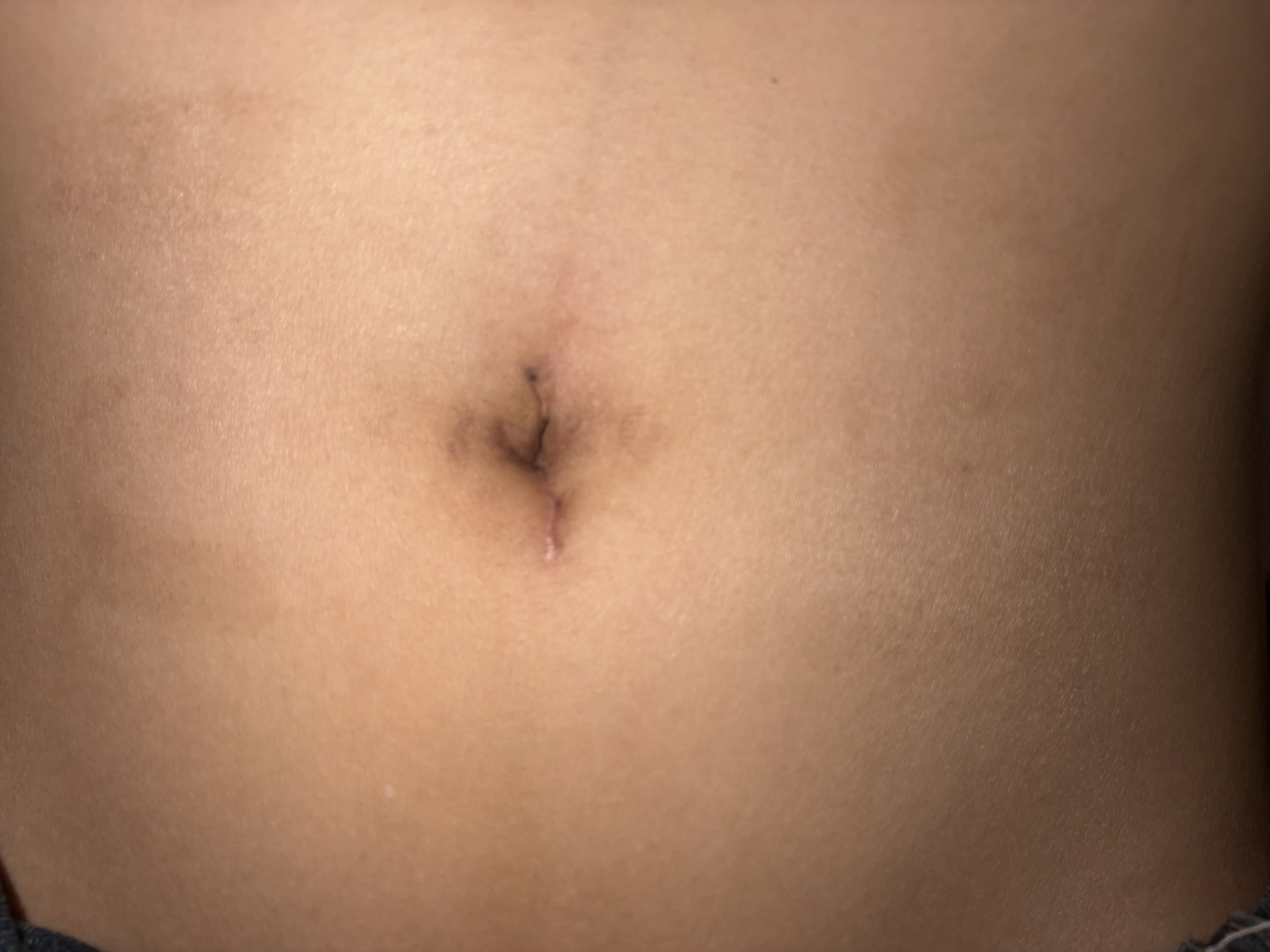 术后一月复查手术伤口几乎无痕