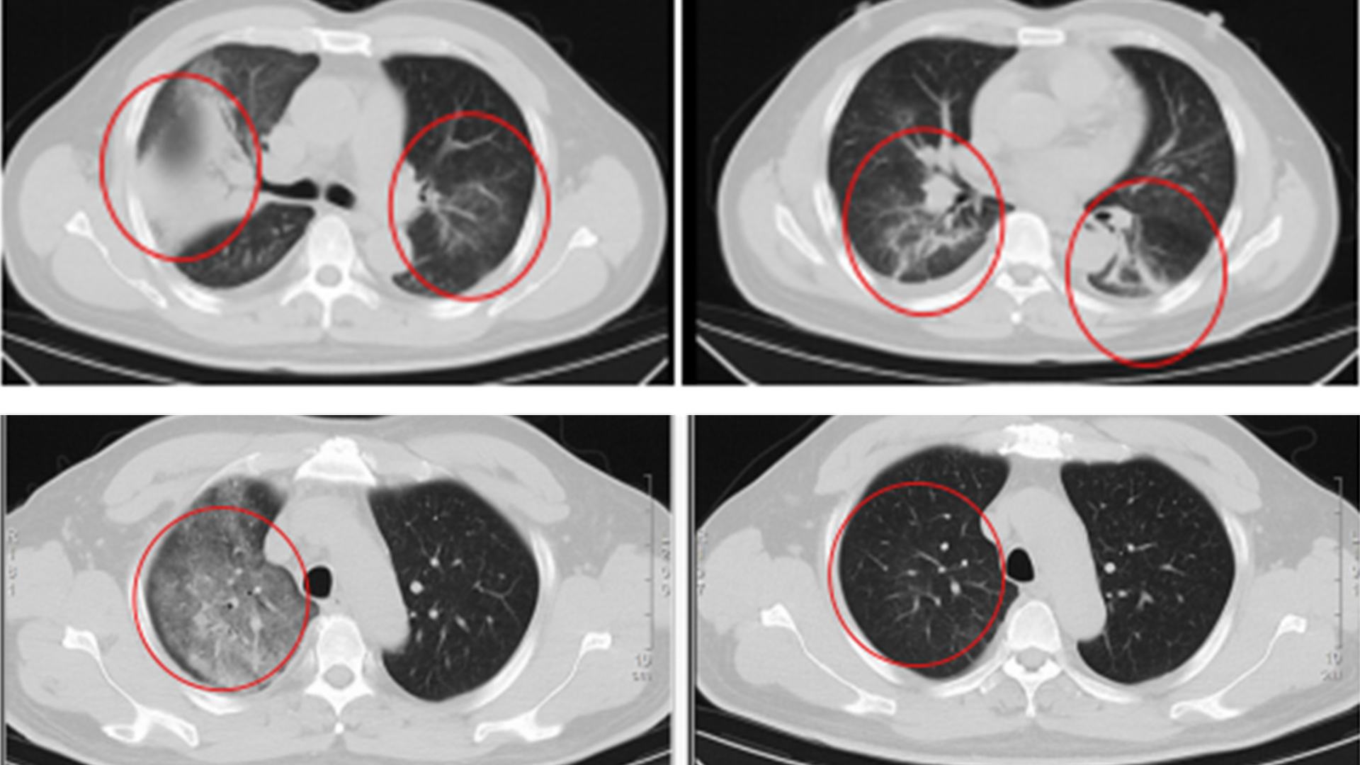 江苏确诊一例罕见传染病“Q热”，当事人病发前刚从非洲回来