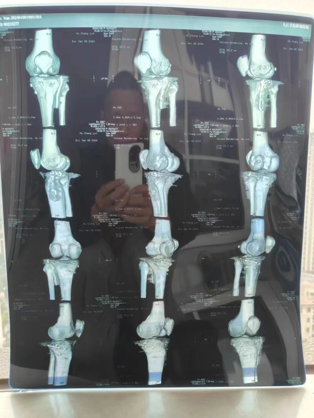 原告受伤后骨折