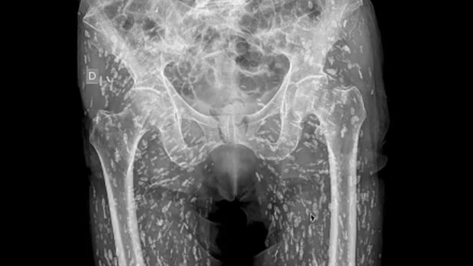 男子因误食未煮熟的猪肉，下半身遍布绦虫卵，X光片令人头皮发麻