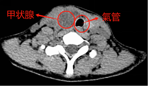 12岁女孩脖子长鸡蛋大肿物,一查竟是肿瘤!