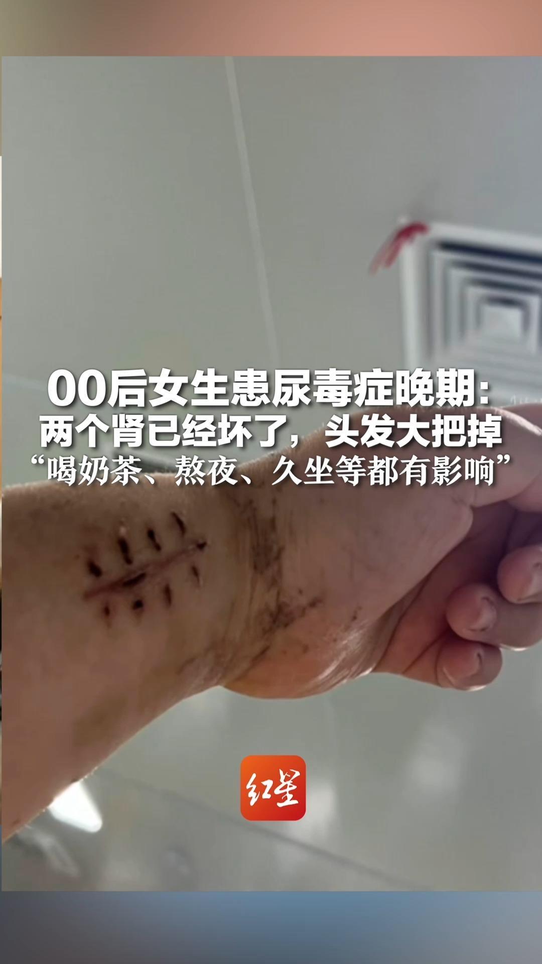 00后女生患尿毒症晚期：两个肾已经坏了，头发大把掉 “喝奶茶、熬夜、久坐等都有影响”