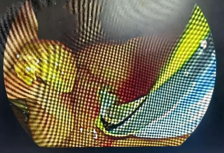 ERCP术中取出黄色结石