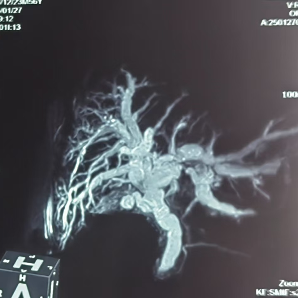MRCP肝内胆管扩展 未见胆道结石