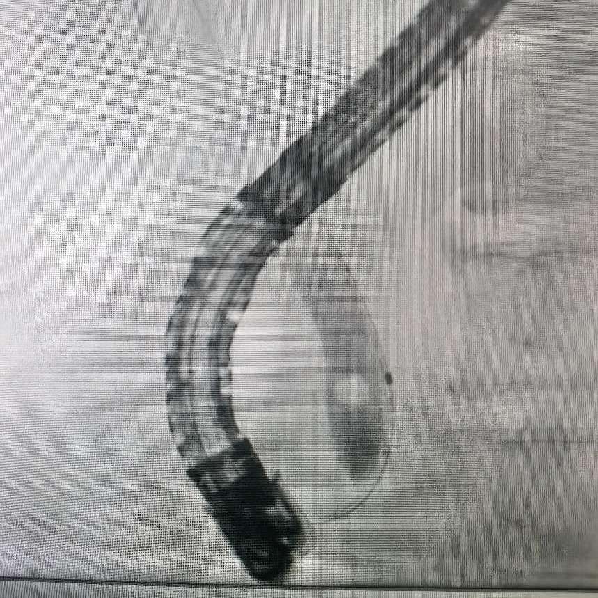 ERCP术中造影见胆总管下段微小结石