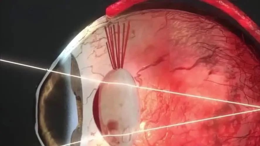 有的老人会得“白内障”从而失明，白内障是什么？