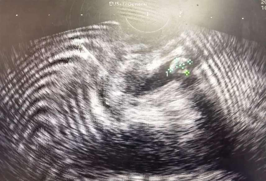 超声内镜（EUS）发现胆总管下段微小结石
