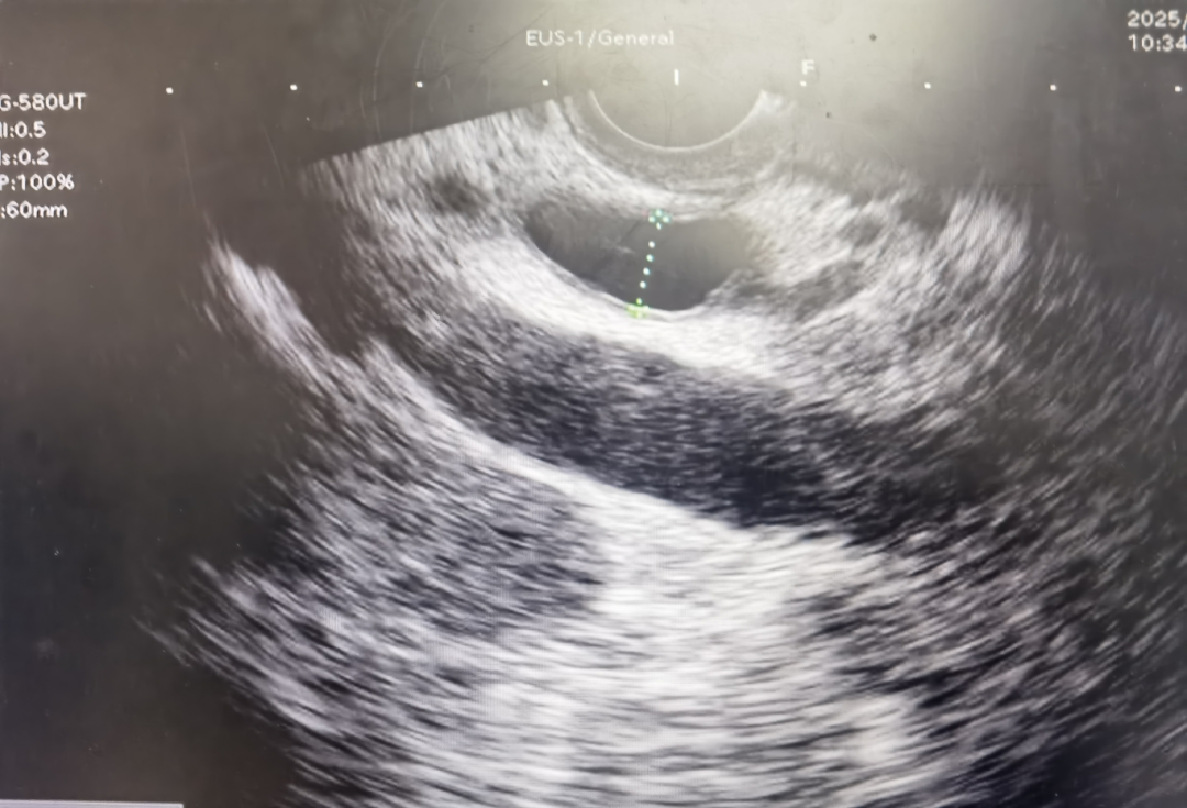 超声内镜（EUS）胆总管上段扩展并胆管炎