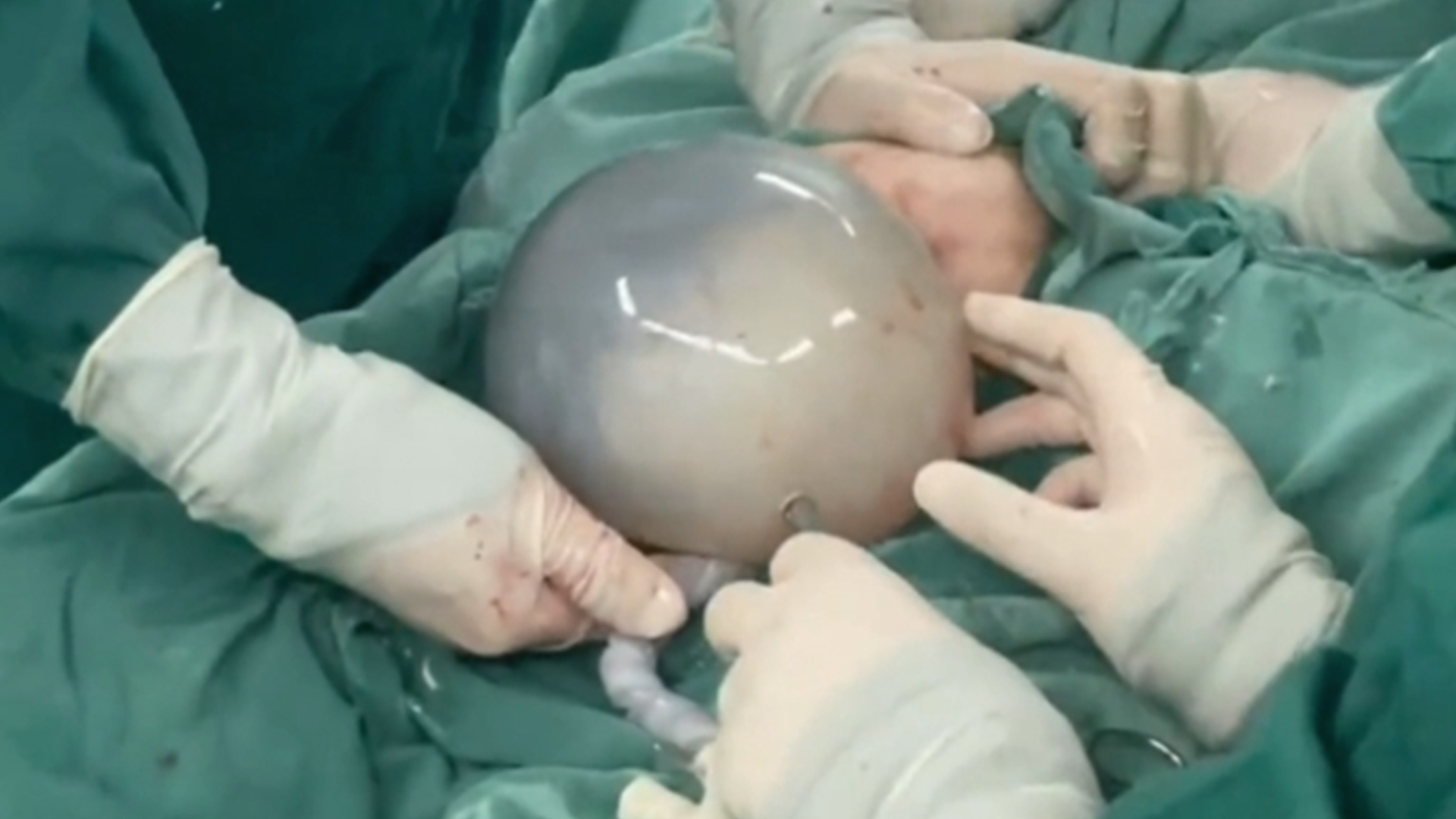 徐州一医院接产“带壳宝宝”，宝宝出生自带“结界”，网友：现实版“小哪吒”