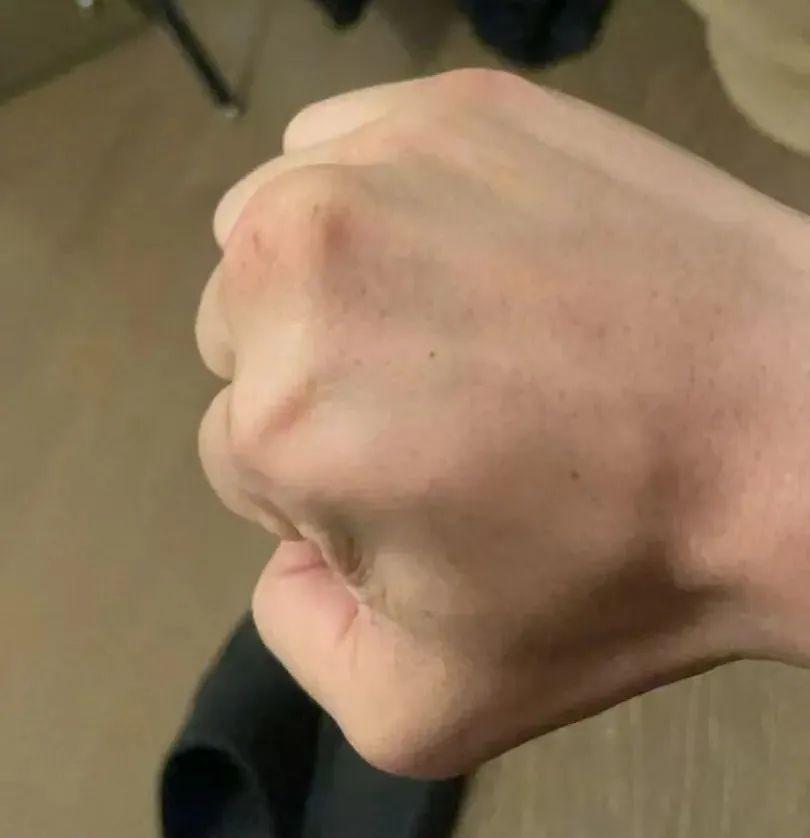 现在黄少康的中指关节仍有变形
