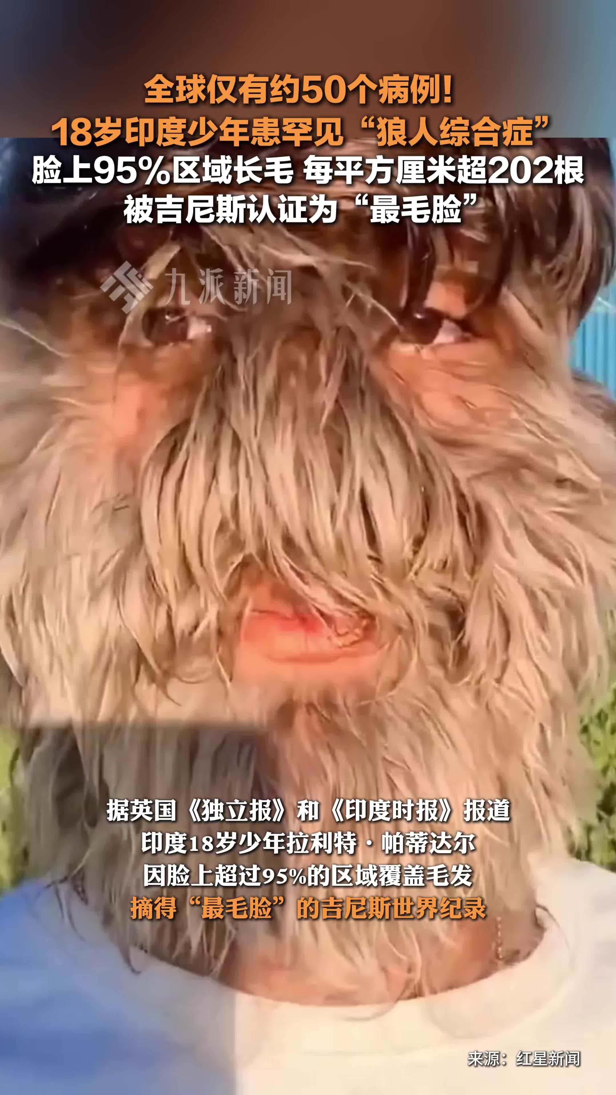 18岁印度少年获得最毛脸吉尼斯纪录