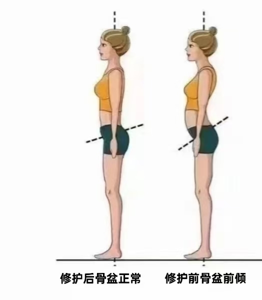 骨盆前倾