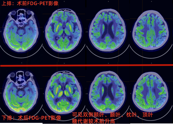 六旬母亲患上阿尔茨海默，深圳医院创新手术帮她找回记忆