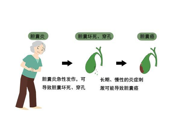 胆囊炎反复发作?专病门诊精准“拆弹”凤凰网陕西_凤凰网