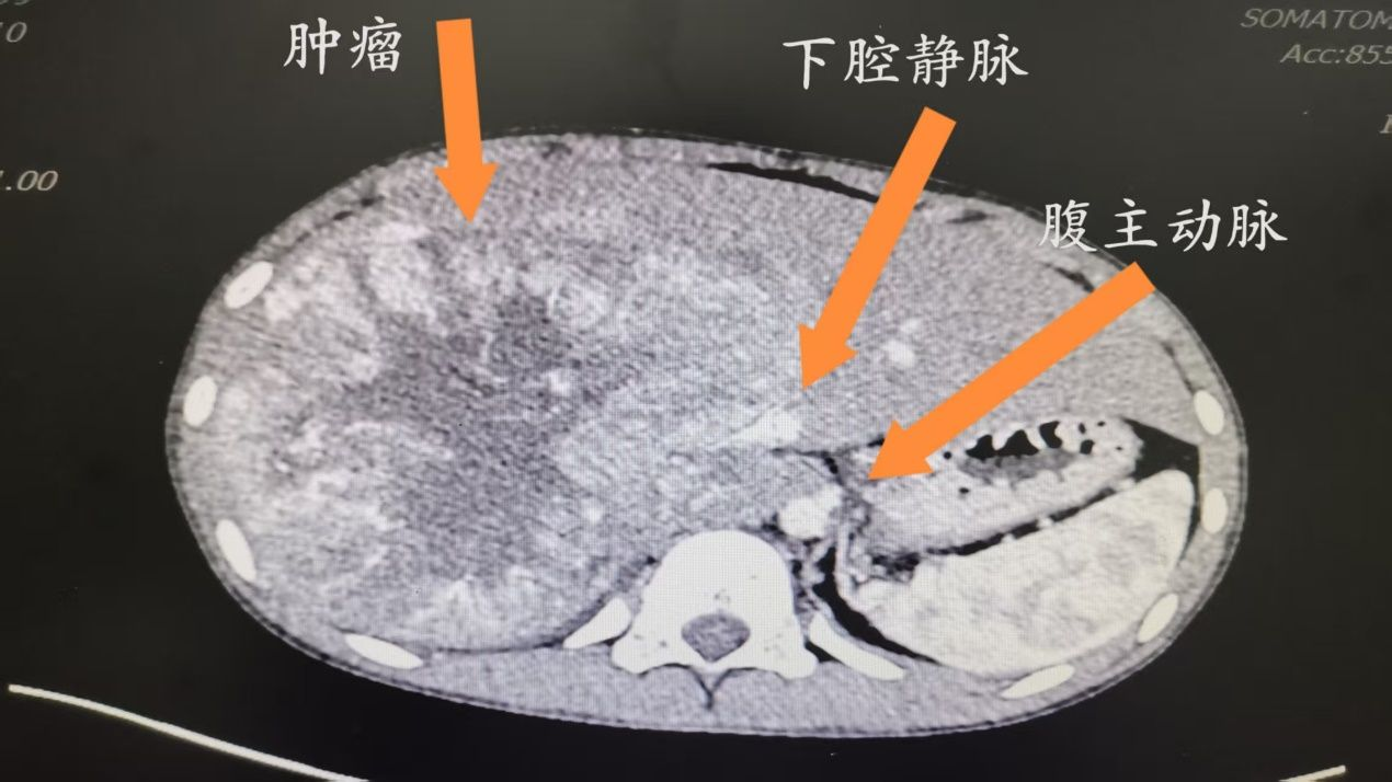儿童罕见肿瘤治疗新突破——西安交通大学第二附属医院完成高难度腹膜后肿瘤联合肝切除