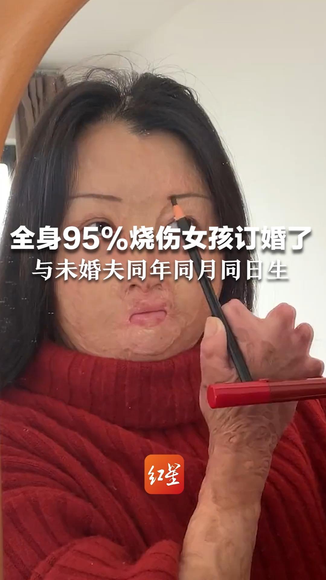 全身95%烧伤女孩订婚了!