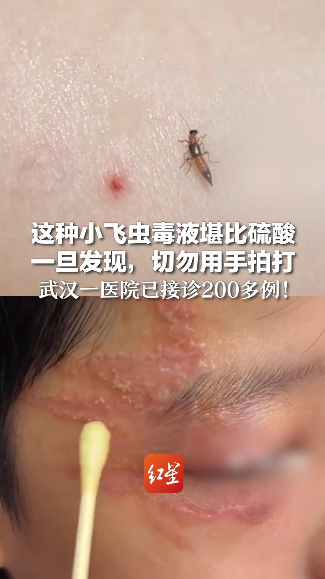 这种小飞虫毒液堪比硫酸  一旦发现，切勿用手拍打 武汉一医院已接诊200多例